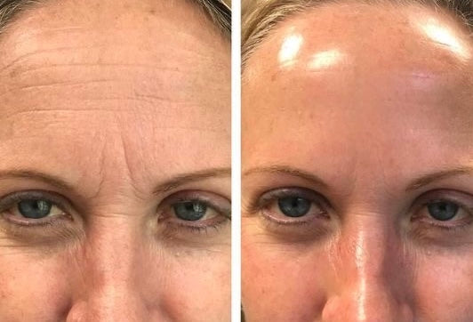 avant après avoir utilisé le sérum la rosa ARTIST